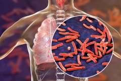 Туберкулез – причины, симптомы, лечение и профилактика