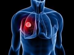 Туберкулез: необходимость ежегодного обследования и шансы на полноценную жизнь