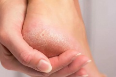 Грибок кожи: симптомы и лечение