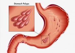 Аденоматозный полип желудка - причины, симптомы, лечение и профилактика