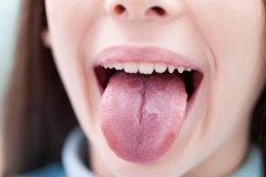  Грибковый стоматит или молочница полости рта