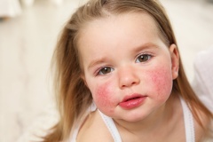 Аллергия у детей - Причины, симптомы, лечение и профилактика