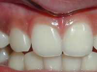 Еще не все потеряно: методы восстановления одного зуба